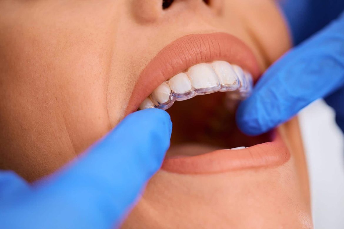 Close-up of a dentist in blue gloves placing a clear aligner tray onto a patient's upper teeth during a dental care checkup.
